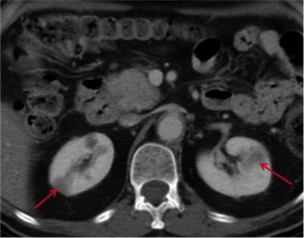 Fig. 21: Axial CECT 65 yo male with AIP and bilateral renal masses (arrows).