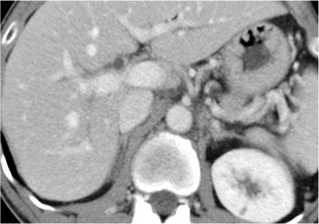 Fig. 23: Axial CECT in a 59 yo man with AIP and biliary dilatation.