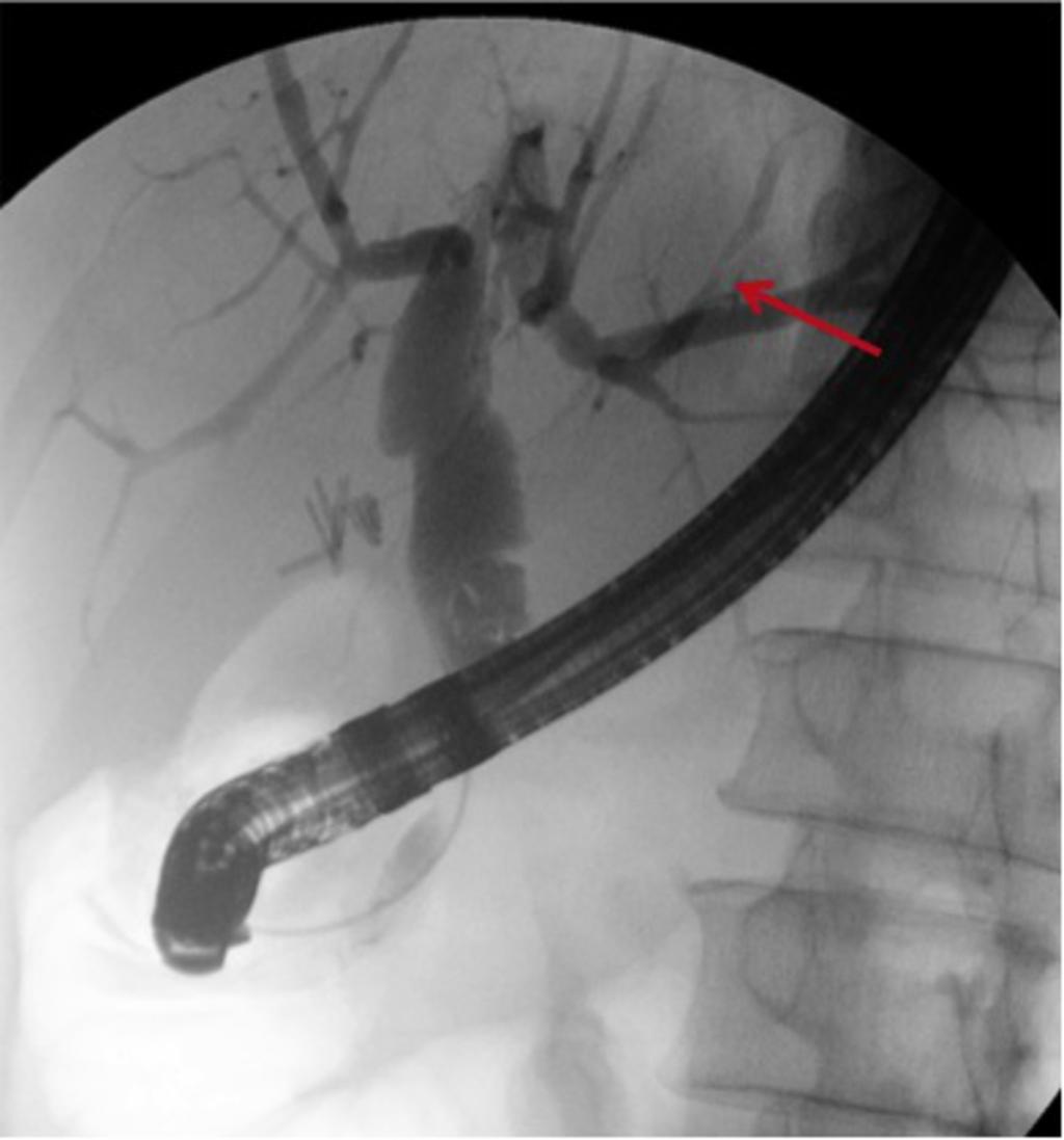 Fig. 25: ERCP image from the same 59 yo male with presumed PSC. The CBD has been cannulated and is moderately dilated.