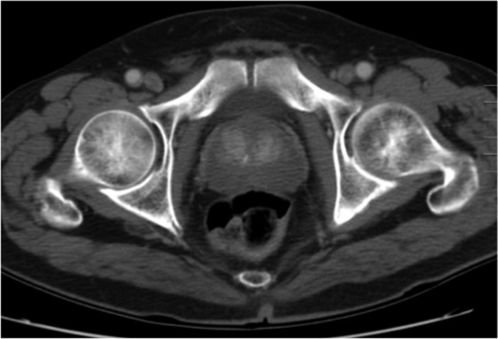 Fig. 26: Axial CECT in a 57 yo male with AIP.