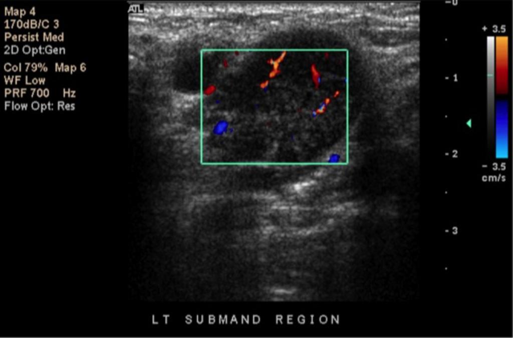 Fig. 27: Color doppler transverse image of enlarged lymph nodes in the submandibular region.