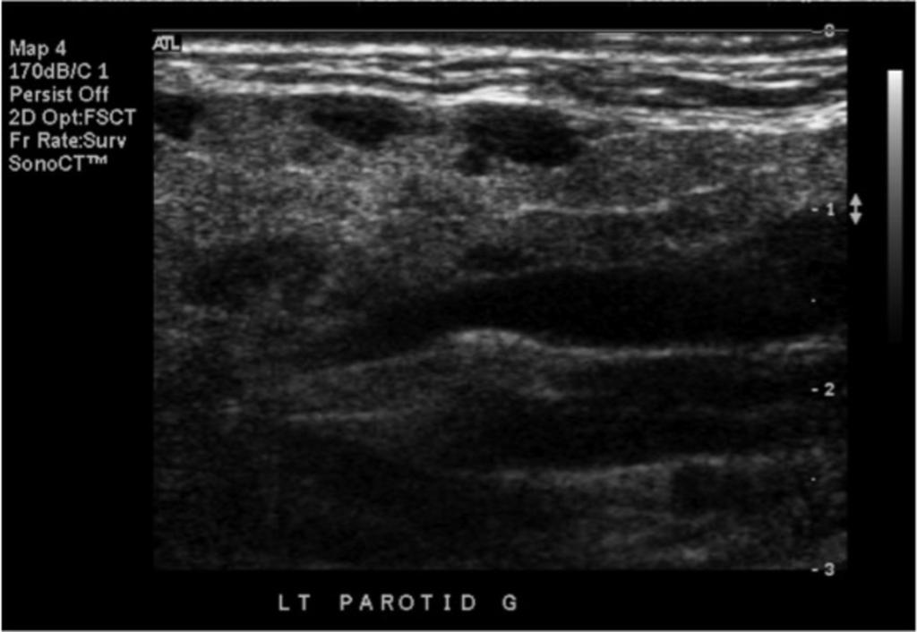 Fig. 28: Grayscale image of only the left parotid gland (although bilateral parotid gland involvement) which has a