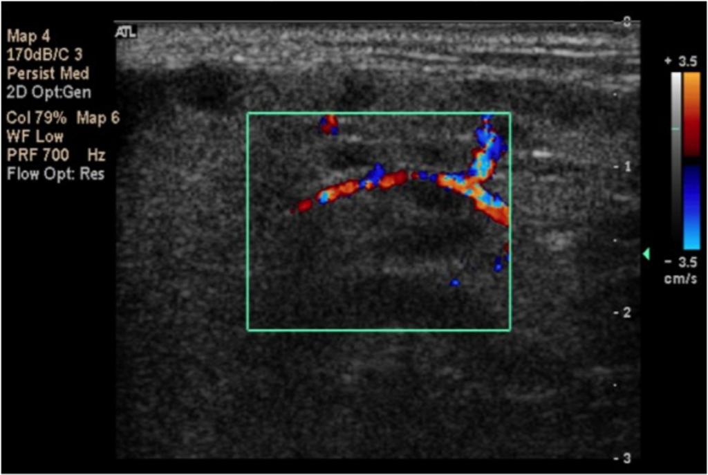 Fig. 29: Color doppler image of only the left parotid gland which has an heterogeneous appearance