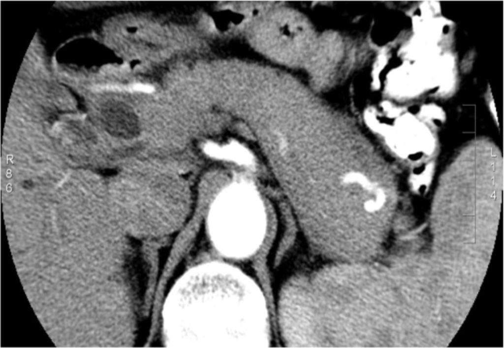 Fig. 1: CECT axial CT in 62 yo female with AIP.