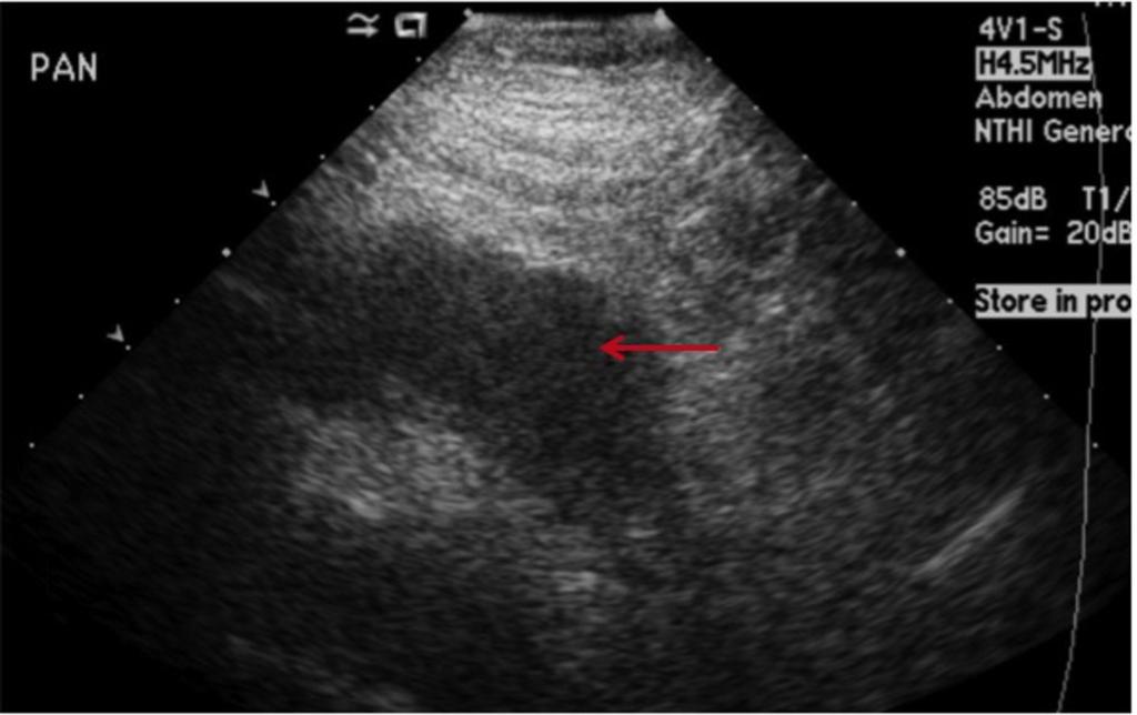 Fig. 2: Grayscale USS showing diffusely enlarged hypoechoic gland with