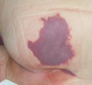 Day 1 - DTPI Day 3 - DTPI Day 10 - Unstageable Day 1 - Classify intact, discolored skin this pressure as a Deep Tissue