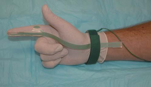 gastro pelvis floor dysfunction 6 anatomic assessment Figure 3 Pudendal nerve-stimulating electrode mounted on the examiner s gloved finger.