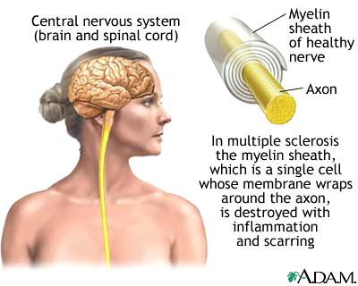 Multiple Sclerosis : Definition A slowly progressive CNS disease characterized by patches of demyelination in the brain and spinal cord, resulting in multiple neurological symptoms MS: Epidemiology