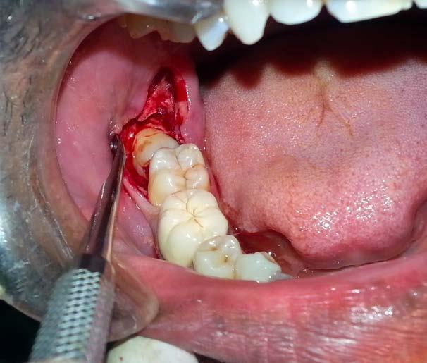 07 Some practicals examples Prophylactic Extraction of Third Molars * Surgical risks * Unnecessary * Painful * A lot of variability concerning the decision * There is a lack of