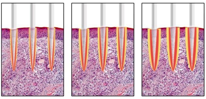 Variable pulse length The adjustable pulse length allows for both cold ablative and thermal treatment This maximizes the results reducing the amount of sessions to two EPITHELIUM LAMINA PROPRIA MAZ*
