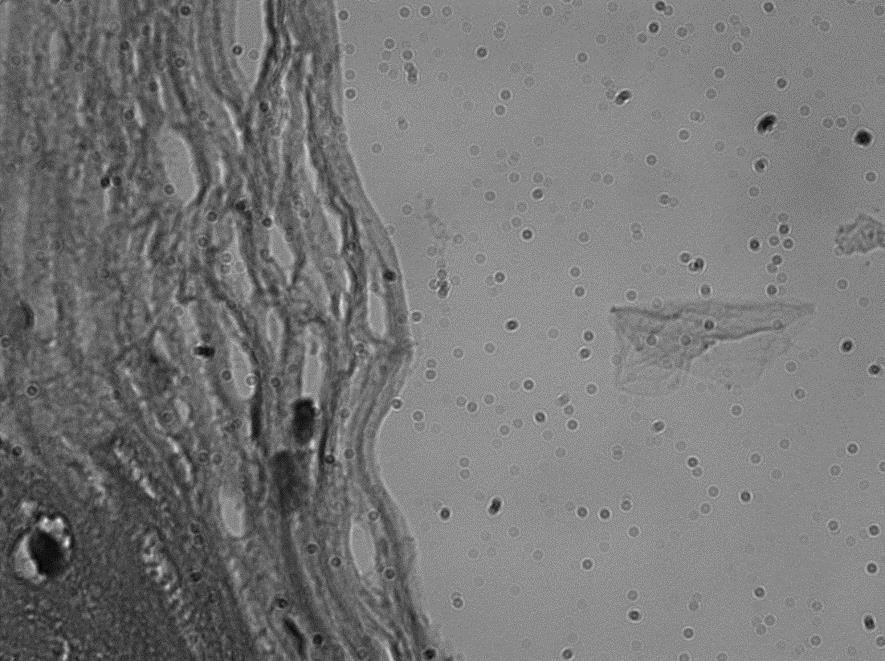 Clinical results Two-photon microscopy image Hematoxylin & Eosin - SETTINGS: Fluence 20 J/cm 2 Pulse duration 300 µs