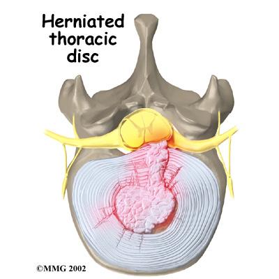 A herniated disc can cut off the blood supply to the spinal cord.