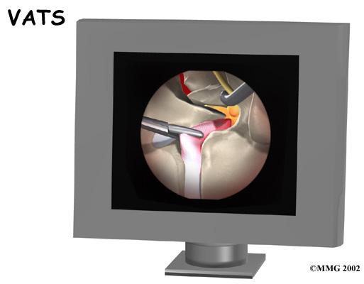 Video Assisted Thoracoscopy Surgery (VATS) Recent developments in thoracic surgery include video assisted thoracoscopy surgery (VATS).