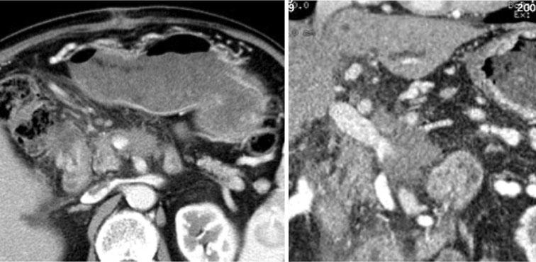 J Hepatobiliary Pancreat Sci (2011) 18:295 303 299 Fig. 5 CT imaging before HIFU; the tumor shows low density Fig. 6 Preparations for HIFU. a Echo jelly was painted thickly over the bombardment area.