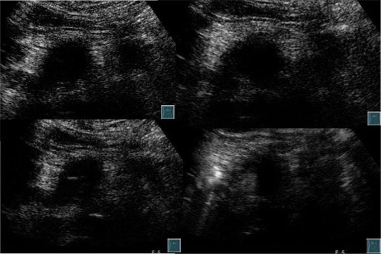 J Hepatobiliary Pancreat Sci (2011) 18:295 303 301 Fig. 10 CE-US imaging after HIFU therapy.