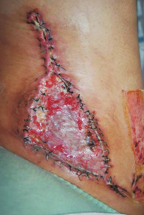 A B A B is 10. In burn and other raw surface wounds, 3 weeks has been traditionally used as cutoff point for surgical intervention like skin graft.