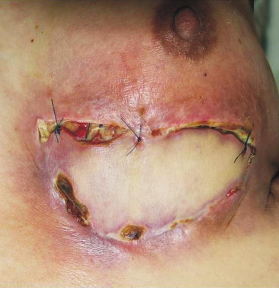 In recent, two theories to explain the pathophysiology of chronic wound healing were proposed.