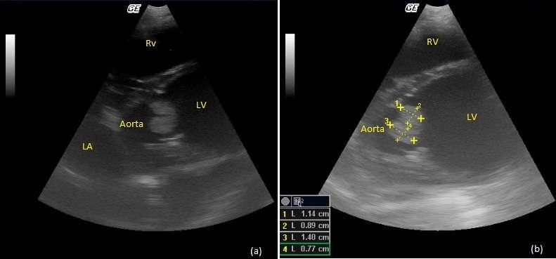 Fig3:(a) and (b) Ecocardiogram of right parasternal long axis view