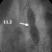 10-12 In a multi-institutional retrospective study, intravascular stent placement was successful in 553 of 565 (98%) procedures.