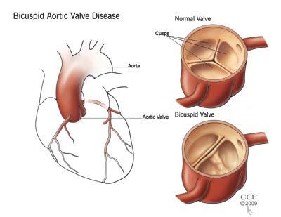 Aortic Aneurysm Other Associations