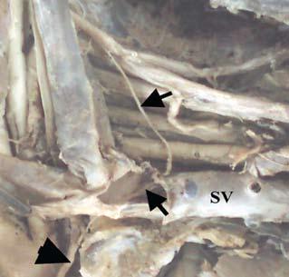 Figure 5: Left side of the neck showing an accessory phrenic nerve (small arrows) passing through the subclavian vein (SV). The anterior wall of the vein was cut to expose the nerve within the vessel.