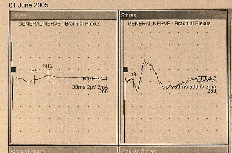 Brachial Plexus Exploration Exposure: Supraclavicular Infraclavicular Investigations: Nerve