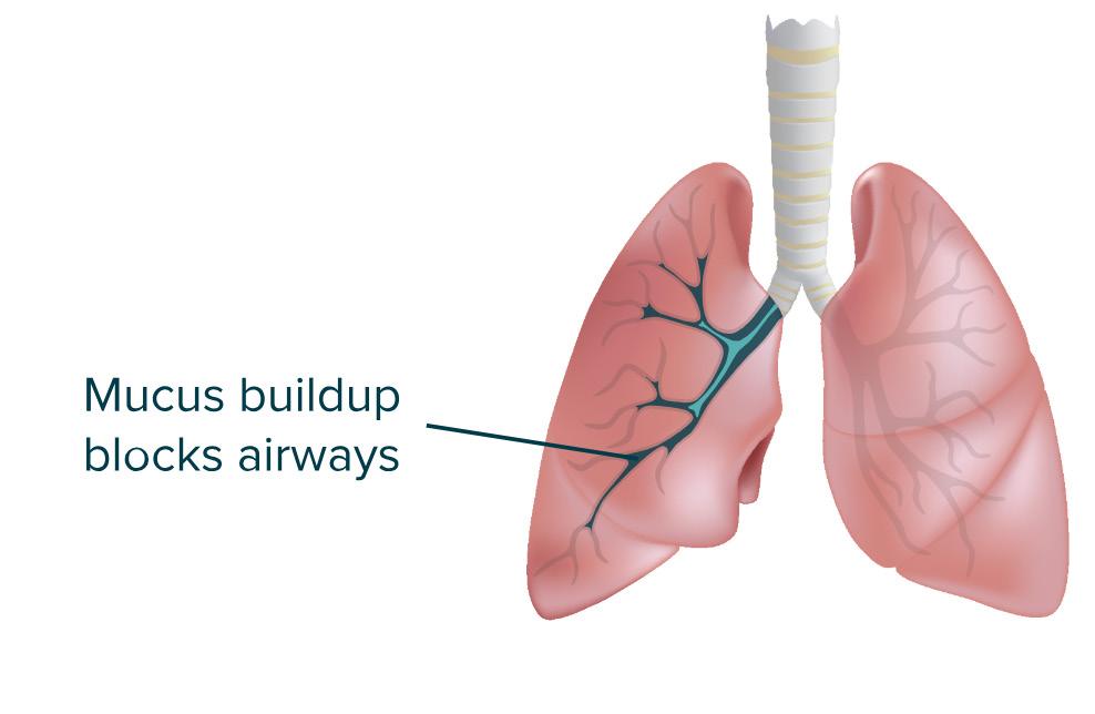 Bronchiectasis What Is Bronchiectasis? Bronchiectasis is a progressive lung disease that causes damage to the airways in your lungs.