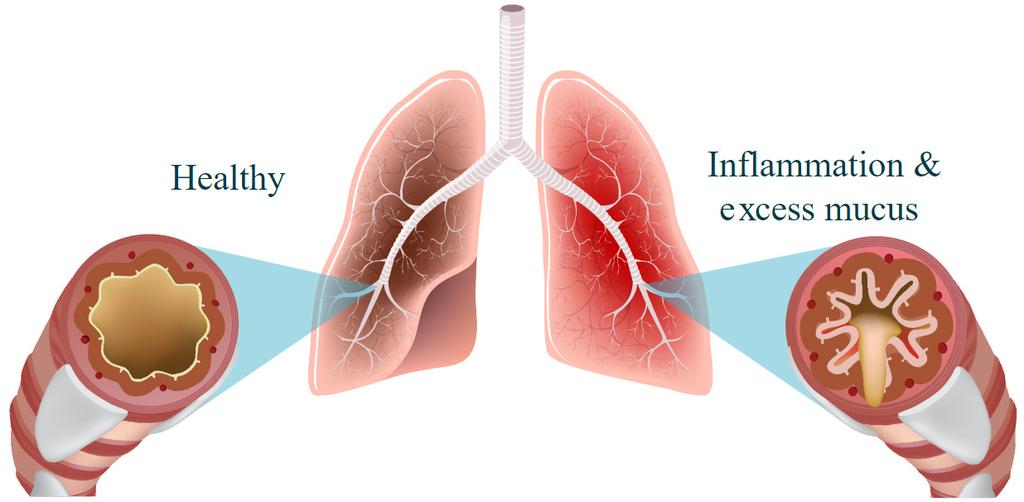 What causes chronic bronchitis? One of the main causes of chronic bronchitis is smoking cigarettes.