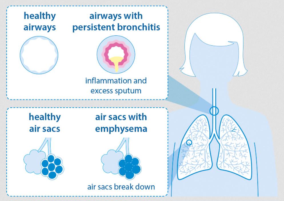 COPD What Is Chronic Obstructive Pulmonary Disease (COPD)? Chronic obstructive pulmonary disease, or COPD, is a group of lung conditions including bronchitis and emphysema.