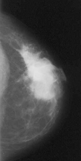 Palpable reast Mass C On examination, note the clockface location, size, texture, tenderness, and mobility of the lump FIGURE 1. simple cyst in the left breast.