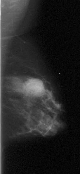 Ultrasonography (C) shows an oval, well-circumscribed, mildly heterogeneous, hypoechoic mass that is wider than tall, indicating a benign mass. ness, and mobility of the lump.