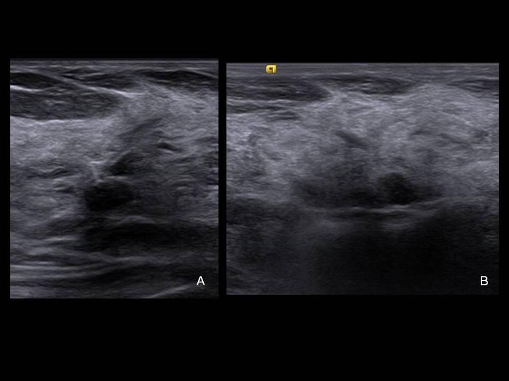 Fig. 7: Ultrasound showed an ill-defined mass (Fig A) and was used to guide the percutaneous vacuum-assisted