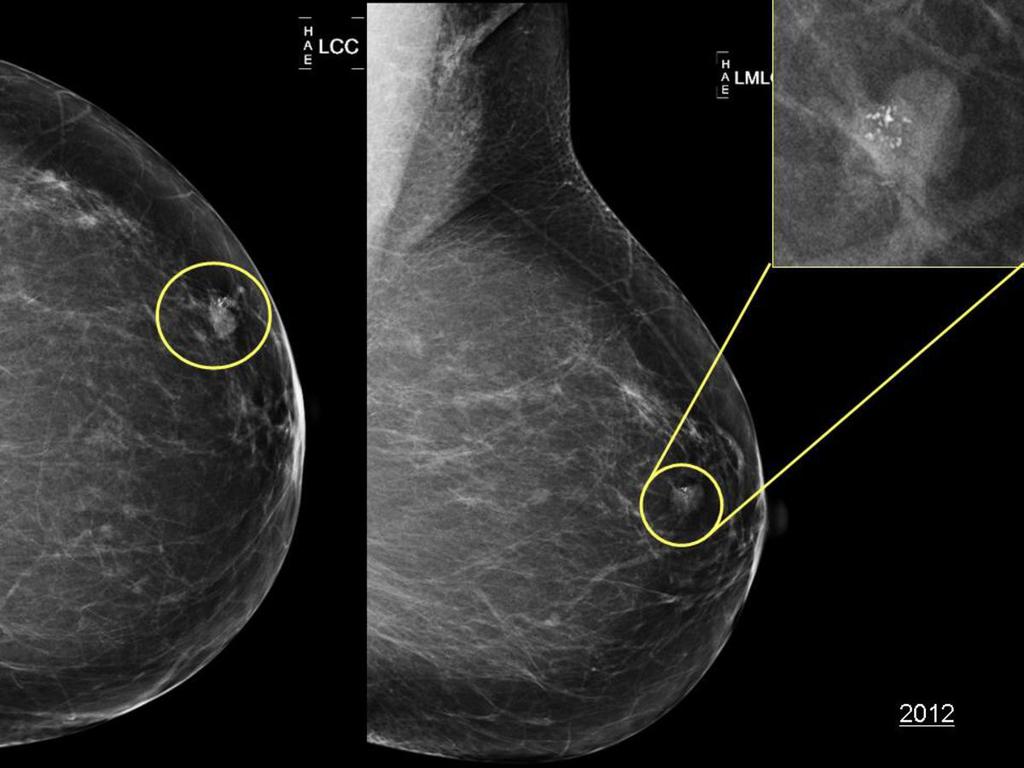 Fig. 9: Case 2: Female, 50 years old, screening mammogram showed an ill-defined mass associated with