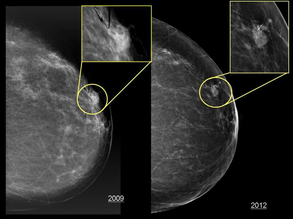 Fig. 10: Prior mammogram from another facility was available for comparison
