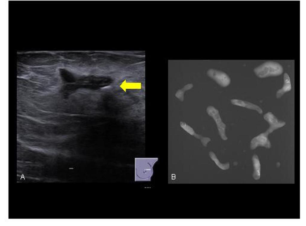 Fig. 12: Figure A - Ultrasound showed this lobulated and ill-defined mass with calcifications within it, corresponding to the mammographic finding and was used to