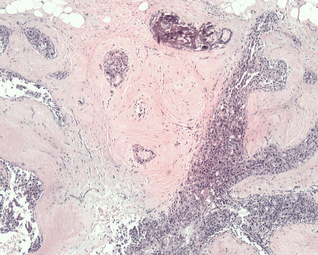 Fig. 13: The result was ductal carcinoma in situ (DCIS) associated with fibroadenoma.