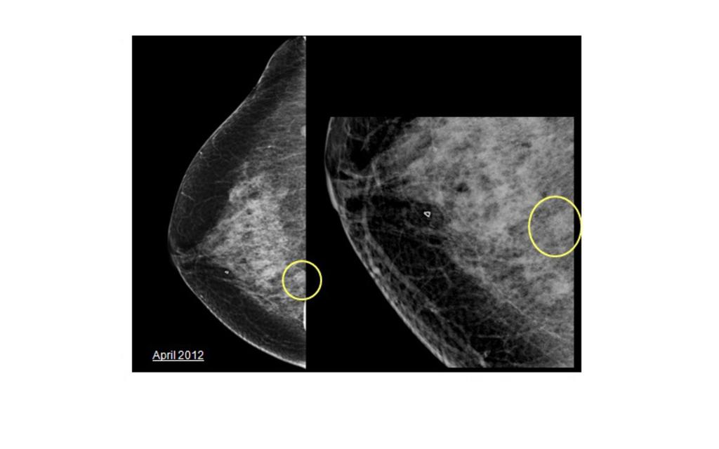 Fig. 15: Case 3: Female, 62 years old, screening mammogram.