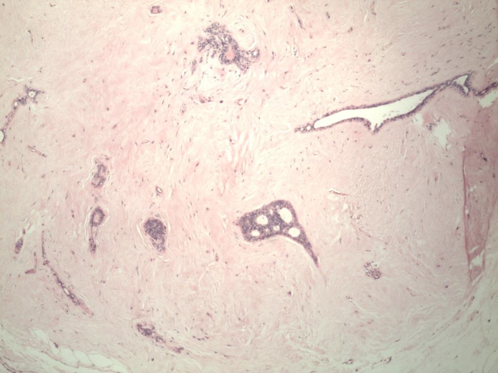 Fig. 20: At low power magnification, typical fibroadenoma architecture.