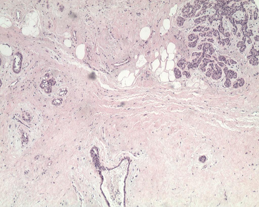 Fig. 25: Low power magnification view discloses typical fibroadenoma.