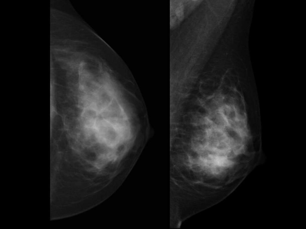 Fig. 28: Case 5 : Female, 31 years old with family history of breast cancer.