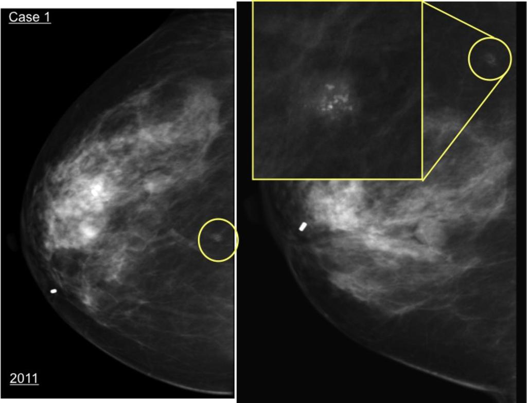 Images for this section: Fig. 1: Case 1: Female, 52 years old with clinical history of two benign biopsies on the right breast (fibroadenomas) in 2009.