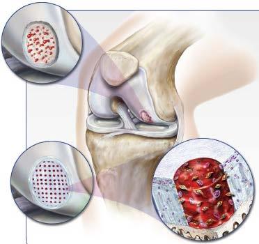 Advanced Arthritis Patient determines the appropriate time for surgical