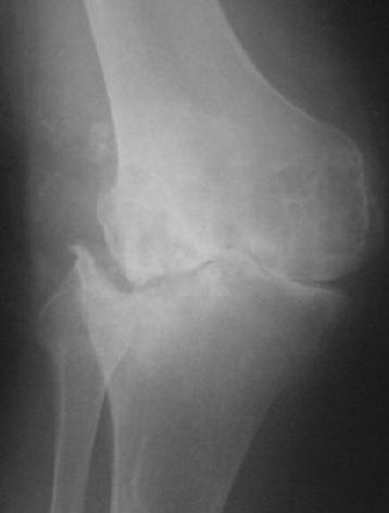 Total Knee Tri-compartmental arthritis Mal-alignment Knee contractures Patient factors Total Knee