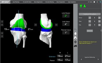 Total Knee Real time guidance Balance knee ligaments Less invasive