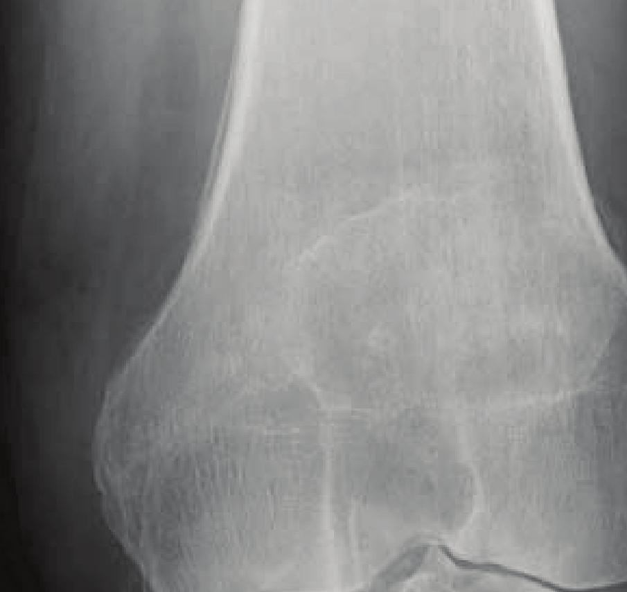 Diagnosis X-ray Evaluation X-rays of an arthritic knee: narrowing of the joint space cystic