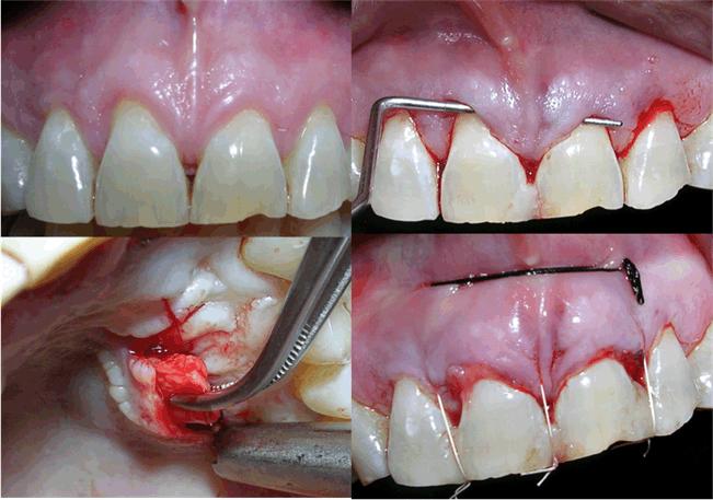 Case 4: This young patient was diagnosed with Millers Class III marginal tissue recession. Tension test was positive in 31. He was apprehensive that he will eventually lose the tooth.