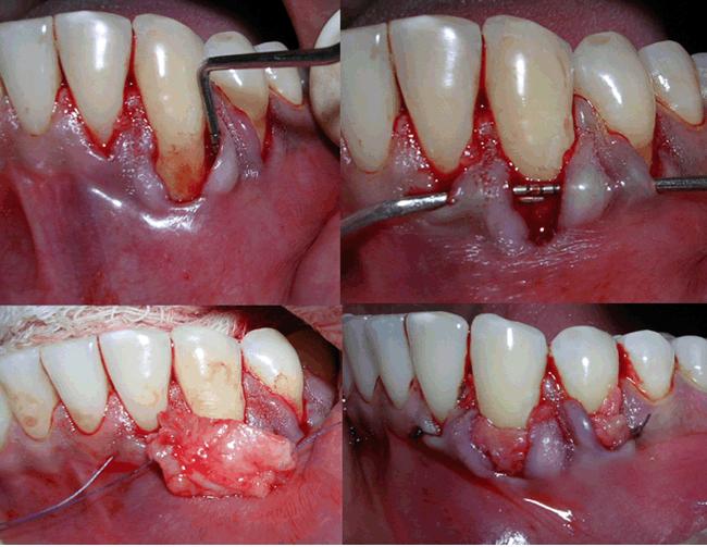 with two vertical incisions to allow access for corticotomy cuts beyond the apex of the teeth.