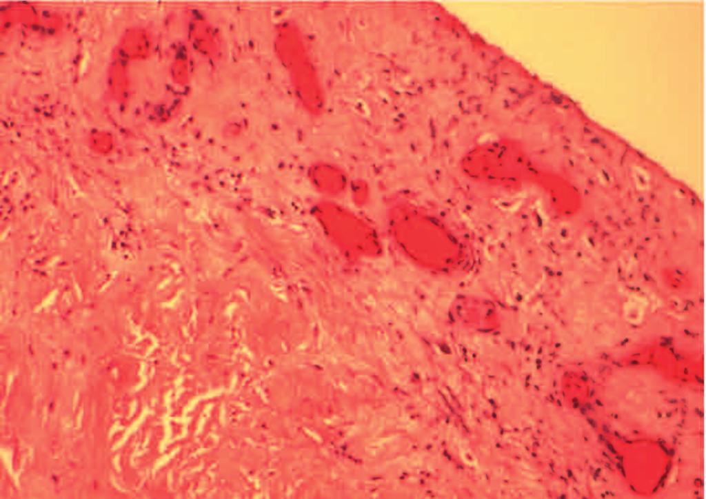Histological analysis of the material was also requested and demonstrated connective tissue with fibrosis and hyalinization.