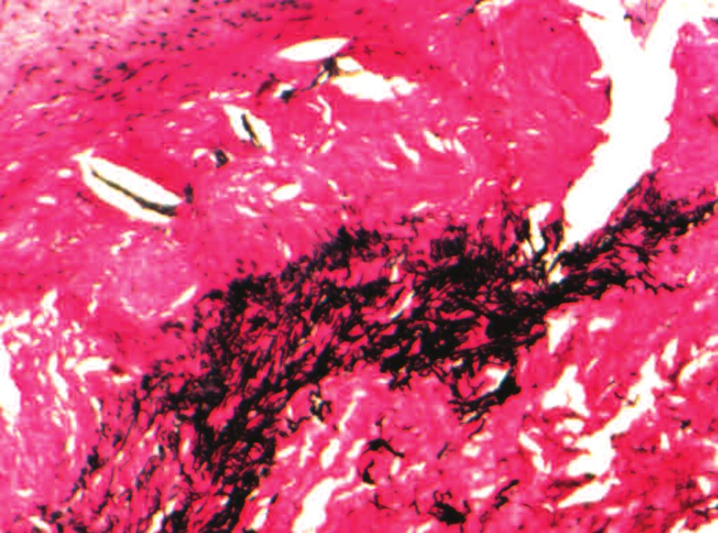 Note also the numerous blood vessels and cellular nuclei in the graft material [FIGURE 3].