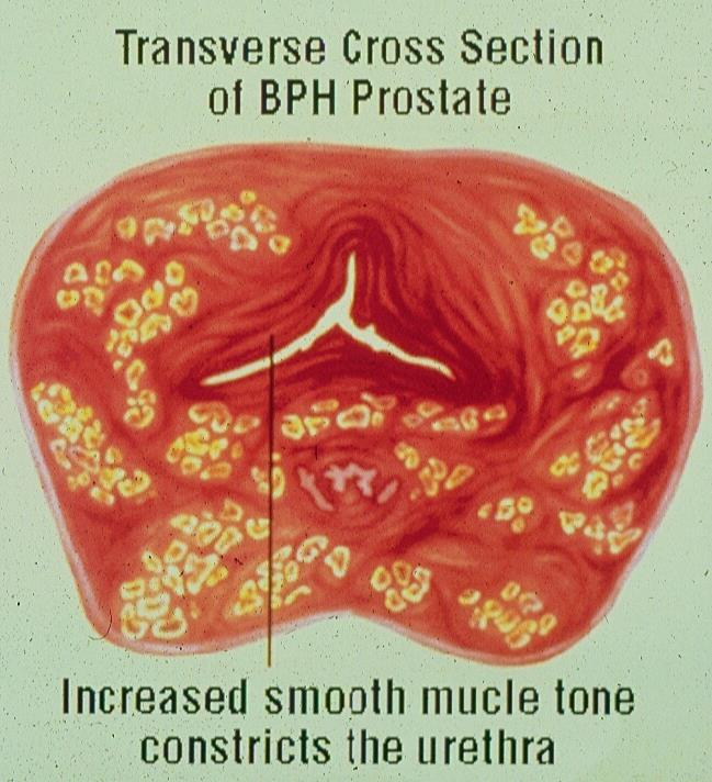 BPH Pathophysiology Static constriction Increased prostate size Dynamic